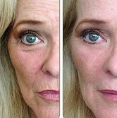 instantlyageless-for-crows-feet